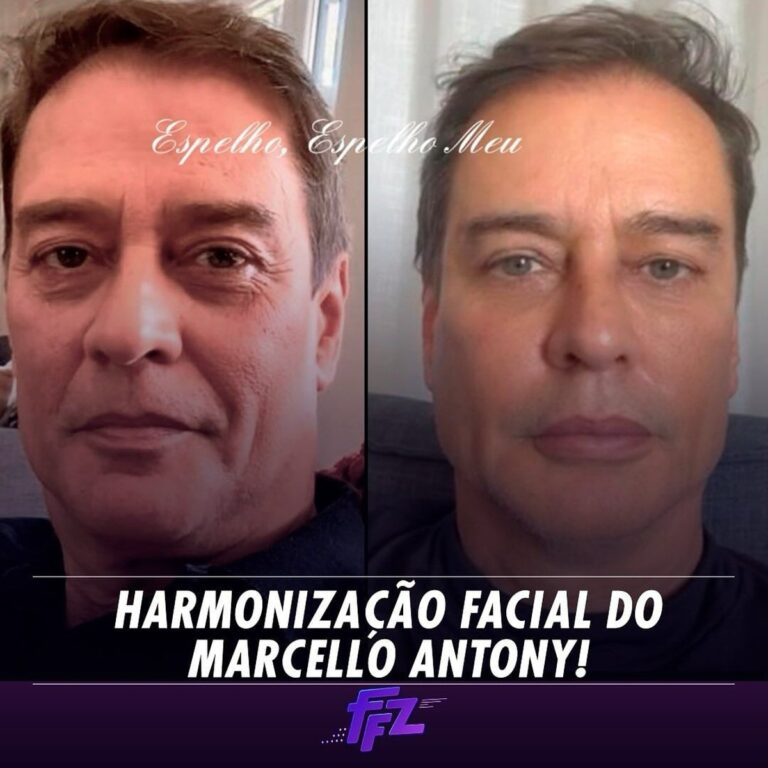 Marcello Antony faz harmonização facial; veja antes e depois