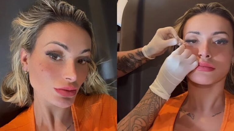 Andressa Urach modifica o rosto de novo após tatuar sardas e preocupa os fãs: 'Chocada'