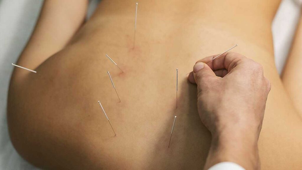 Senado propõe ampliar acesso à acupuntura, homeopatia e ioga no SUS